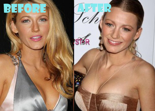 Blake Lively Before And After Breast Implants 