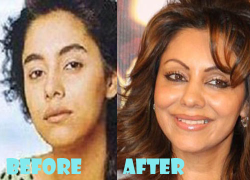 Gauri Khan Plastic Surgery Before and After Pictures - Lovely Surgery