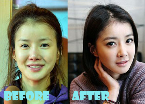 Lee Si Young Plastic Surgery