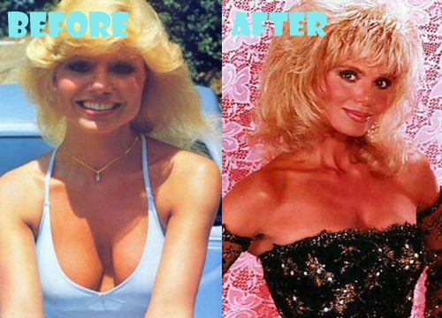 Reduction loni anderson before breast Breast Reduction