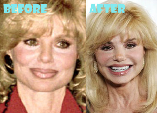 Before reduction breast anderson loni Loni Anderson