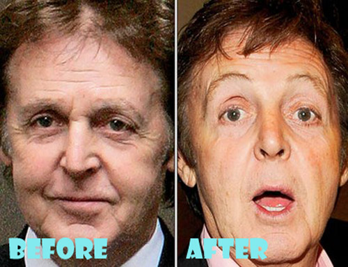 Paul McCartney Plastic Surgery Botox