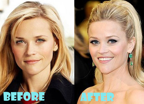 Reese Witherspoon Plastic Surgery Botox