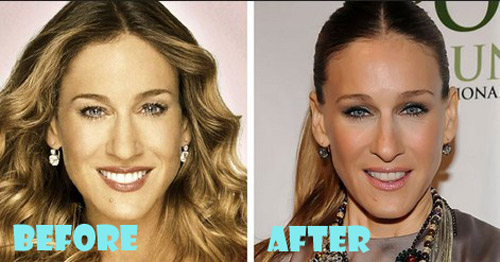 Sarah Jessica Parker Plastic Surgery before after
