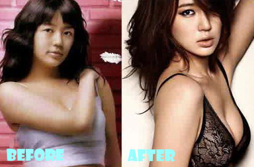 Yoon Eun Hye Plastic Surgery Breast Implant