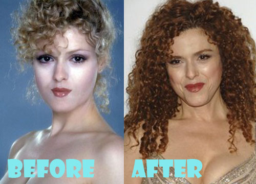 Bernadette Peters Plastic Surgery Botox, Facelift