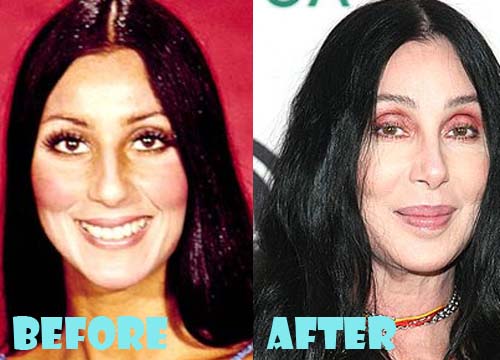 Cher Overdoing Plastic Surgery