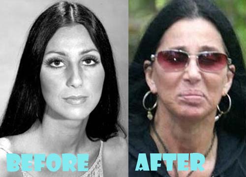 Cher Plastic Surgery Facelift