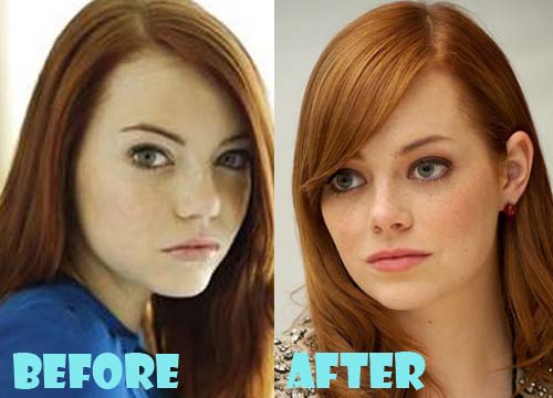 Emma Stone Plastic Surgery Before and After Nose Job ...