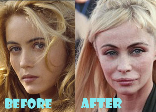 Emmanuelle Beart Plastic Surgery Before And After Pictures Lovely Surgery 