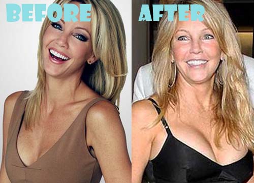 heather locklear surgery plastic breast before implant celebrity lovely lovelysurgery