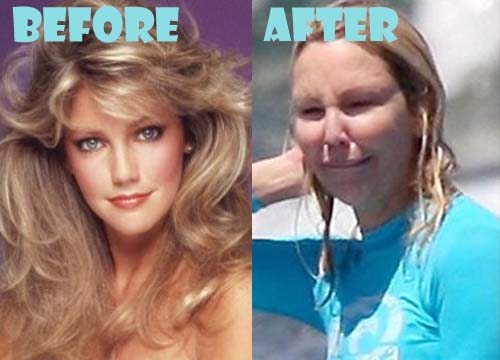 Heather Locklear Plastic Surgery Before And After Photos Lovely Surgery 