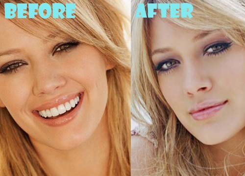 Hilary Duff Plastic Surgery Nose Job