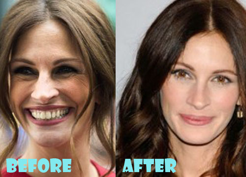 Julia Roberts Plastic Surgery Before And After Pictures Lovely Surgery