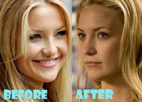 Kate Hudson Plastic Surgery Before And After Nose Job Lovely Surgery