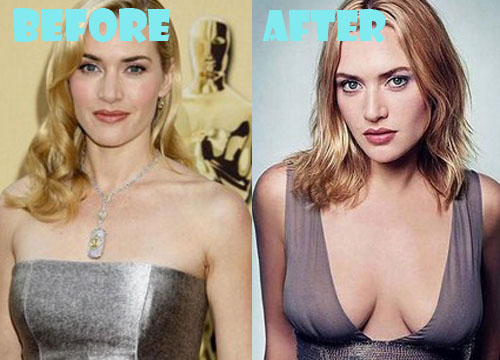 Kate Winslet Plastic Surgery Breast Implant