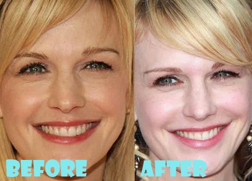 Kathryn Morris Plastic Surgery Botox