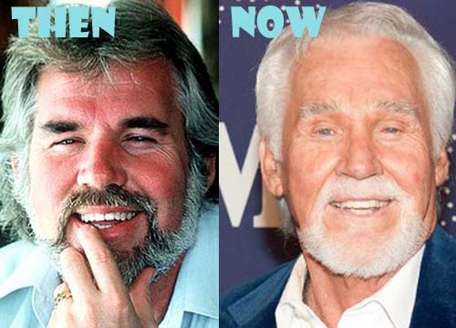 kenny rogers before and after