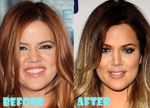 Khloe Kardashian Plastic Surgery Nose Job