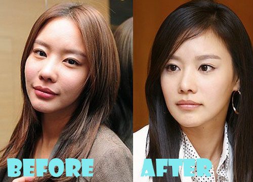 Kim Ah Joong Plastic Surgery Before And After Photos Lovely Surgery 9893