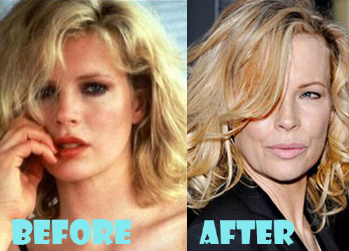 Kim Basinger Plastic Surgery Nose Job