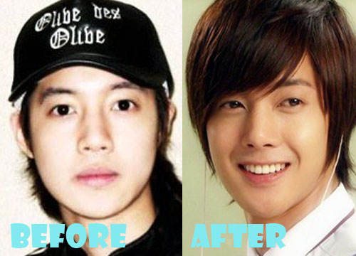 Kim Hyun Joong Plastic Surgery Nose Job