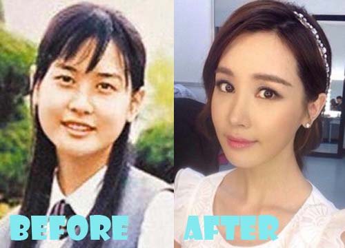 Lee Da Hae Plastic Surgery Before and After Pictures - Lovely Surgery