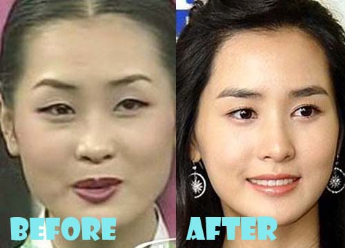 Lee Da Hae Plastic Surgery