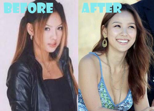 Lee Hyori Plastic Surgery Breast Implant