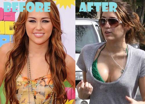 Miley Cyrus Plastic Surgery Breast Implant