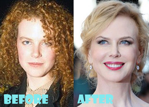 Nicole Kidman Plastic Surgery Botox