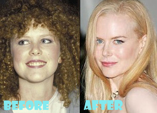Nicole Kidman Plastic Surgery