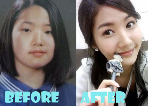Park Min Young Plastic Surgery