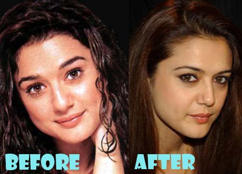 Preity Zinta Plastic Surgery