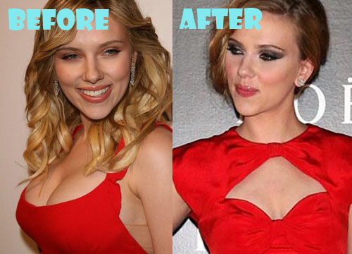 Scarlett Johansson Plastic Surgery Boob Job