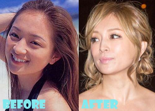 Ayumi Hamasaki Plastic Surgery Nose Job