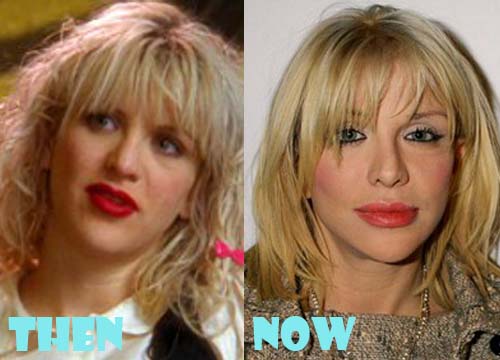 Courtney Love Plastic Surgery Facelift