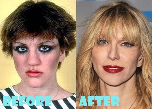 Courtney Love Plastic Surgery Before And After Photos Lovely Surgery Celebrity Before And