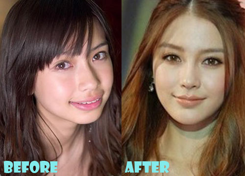 surgery angelababy lovelysurgery