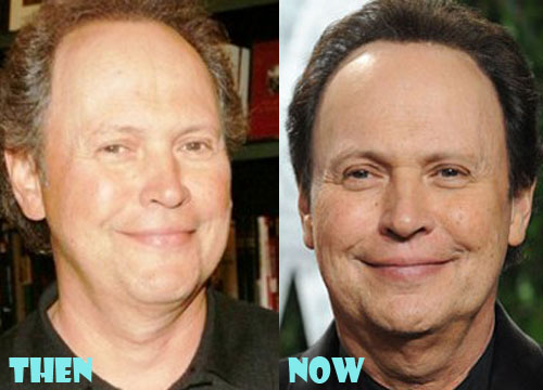 Billy Crystal Plastic Surgery Botox, Facelift