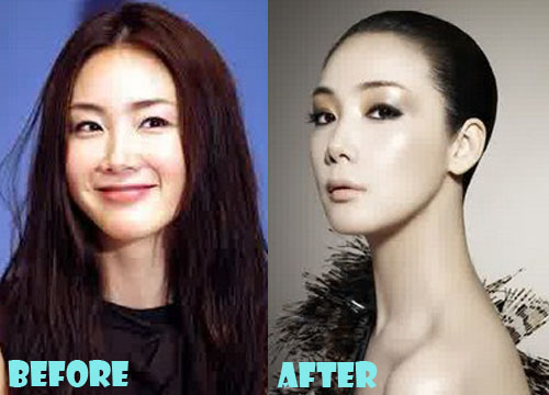 Choi Ji Woo Plastic Surgery Nose Job