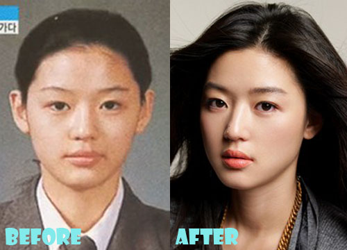 Jun Ji Hyun Plastic Surgery Nose Job
