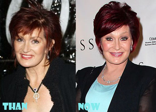 Sharon Osbourne Plastic Surgery Botox, Facelift