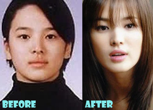 Song Hye Kyo Plastic Surgery Eyelid Surgery