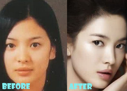 Song Hye Kyo Plastic Surgery Nose Job