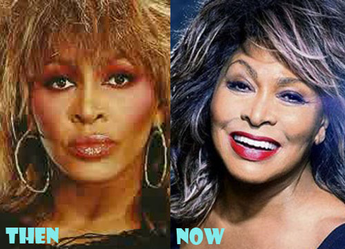 Tina Turner Plastic Surgery Botox, Facelift