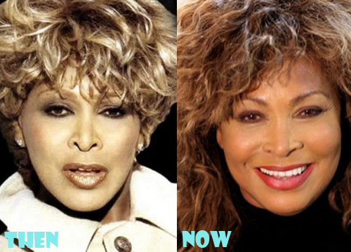 Tina Turner Plastic Surgery
