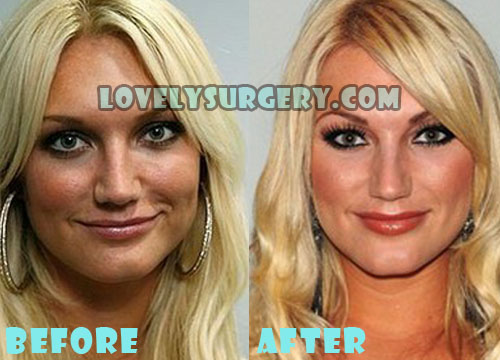 Brooke Hogan Plastic Surgery Nose Job