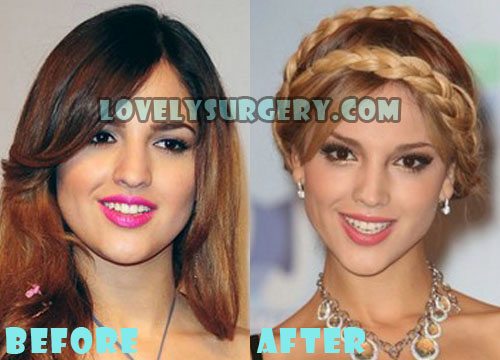 Eiza Gonzalez Plastic Surgery