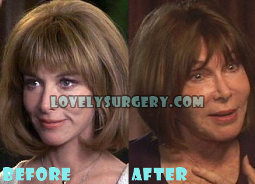 Lee Grant Plastic Surgery Gone Wrong
